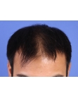 Before Hair Transplant&nbsp;2 Sessions (Areas)